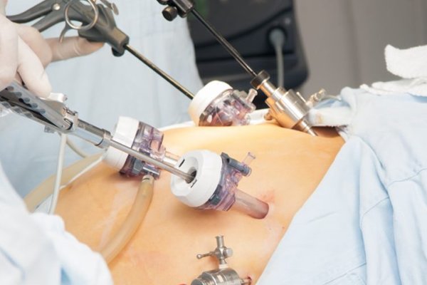 3D Laparoscopy System